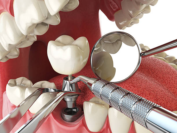 Best Emergency Tooth Extraction in Miramar Beach, FL